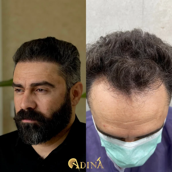 قبل و بعد کاشت مو