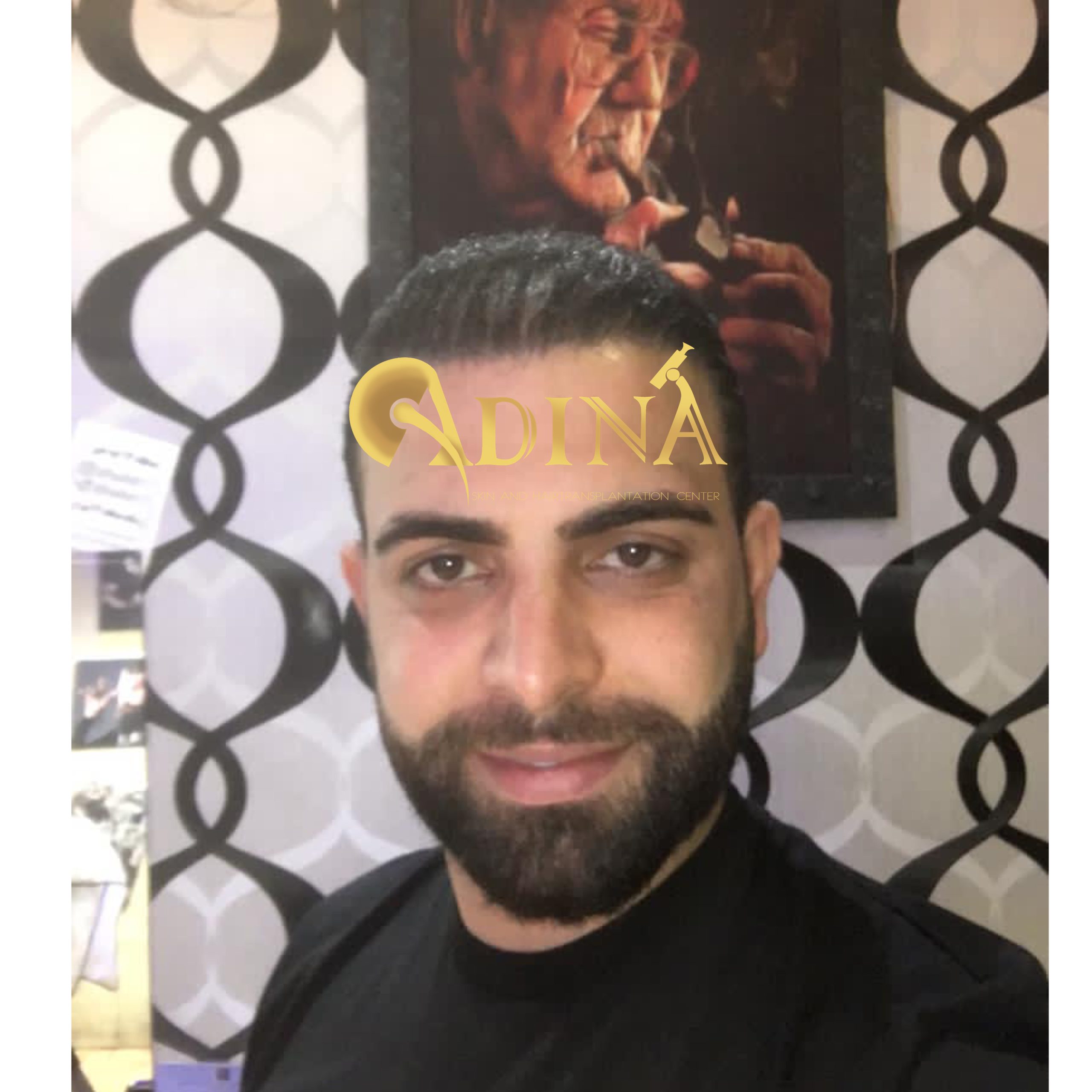 یک ماه بعد از کاشت مو.