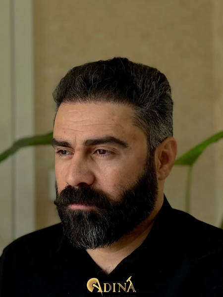 کاشت مو بعد از یک ماه