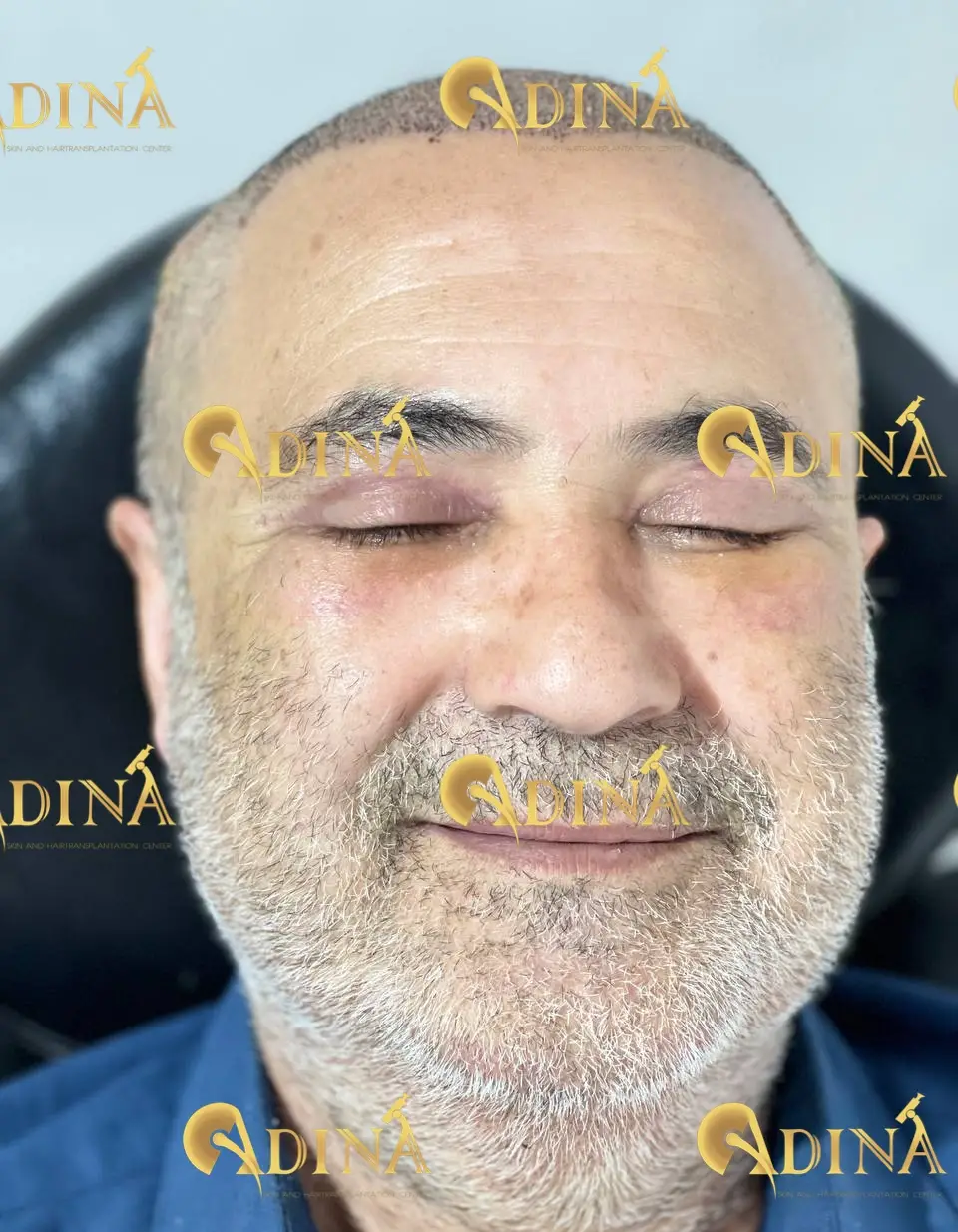 بعد از جراحی پلک